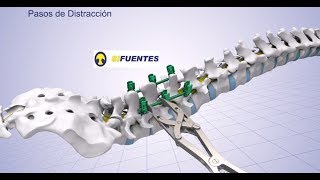 Fijación Con Tornillos Poliaxiales [upl. by Imotas]