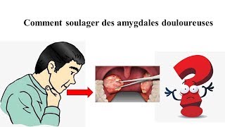 Comment soulager des amygdales douloureuses  Santé générale [upl. by Maag634]