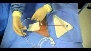 Insertion of Transvenous Pacemaker [upl. by Lek]