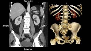 Normal Renal Anatomy [upl. by Eveneg]