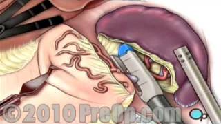 Spleen Removal Laparoscopic PreOp® Patient Education [upl. by Eirrod139]