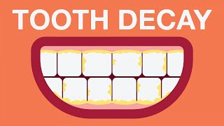 What causes tooth decay [upl. by Ailat]