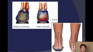 Plantar fasciitis Signs symptoms and treatment options [upl. by Inanuah]