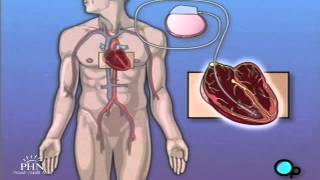 Permanent Pacemaker Implant Surgery [upl. by Eillac578]