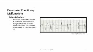 Pacemaker Overview [upl. by Marylynne]