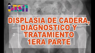 Displasia de Cadera Diagnostico y Tratamiento 1era Parte  Telecapacitaciones INSN [upl. by Solotsopa]