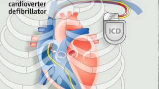 How pacemakers work [upl. by Klapp]