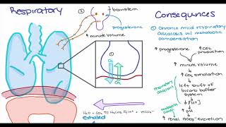 Hypertensive disorders in Pregnancy [upl. by Nyrraf]