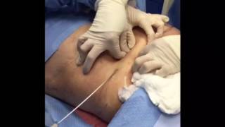 Tumescent Liposuction for Fat Removal [upl. by Yenterb869]