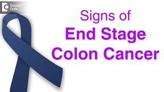 What Are the Symptoms of Colon Cancer [upl. by Cressler]