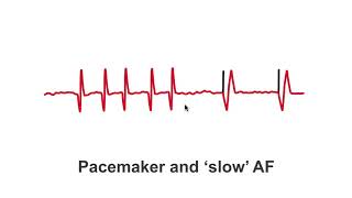 Pacemakers and quotslowquot AF patients [upl. by Aitram365]