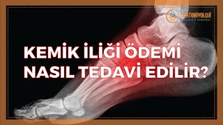 KEMİK İLİĞİ ÖDEMİ NASIL TEDAVİ EDİLİR [upl. by Aitnauq]