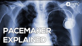 Pacemaker Explained  NMC Doctor Video [upl. by Kathy]