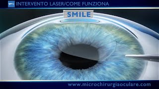 Intervento Laser Occhi Come Funziona [upl. by Ynohtnacram]