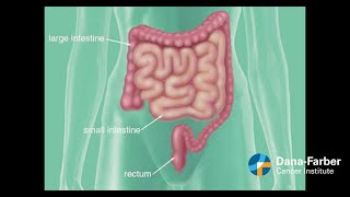 Colorectal Polyps Causes Signs and Symptoms Diagnosis and Treatment [upl. by Ihc]