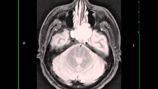 Adrenoleukodystrophy  causes symptoms diagnosis treatment pathology [upl. by Chally]