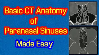 Basic CT Anatomy of Paranasal Sinuses Made Easy [upl. by Finegan]