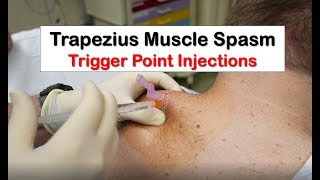 Trapezius Muscle Spasm Trigger Point Injection [upl. by Iahcedrom]