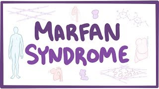 Marfan Syndrome  Diagnosis by Prof Julie De Backer [upl. by Penrod]