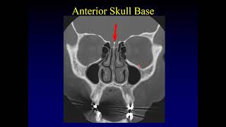 Imaging of the Paranasal Sinuses 1 [upl. by Naoma]