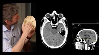 Paranasal sinuses CT imaging anatomy [upl. by Ennayt878]