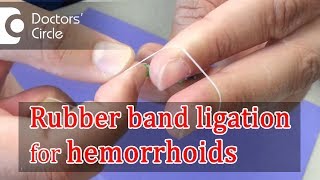 What is Rubber Band Ligation  Dr Rajasekhar M R [upl. by Otilia]