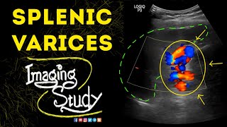 Splenic Varices  Ultrasound  Case 49 [upl. by Vadnee]