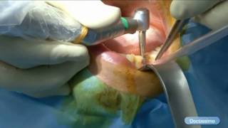 La pose dun implant en pratique [upl. by Eiclehc]